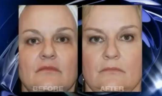 Tineretea eterna fara bisturiu: misiune posibila. Liftingul lichid te scoate din incurcatura