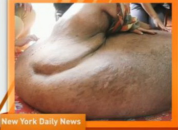 Se lupta cu o tumoare care-i creste din copilarie, in ciuda operatiilor. Acum cantareste 80 de kg