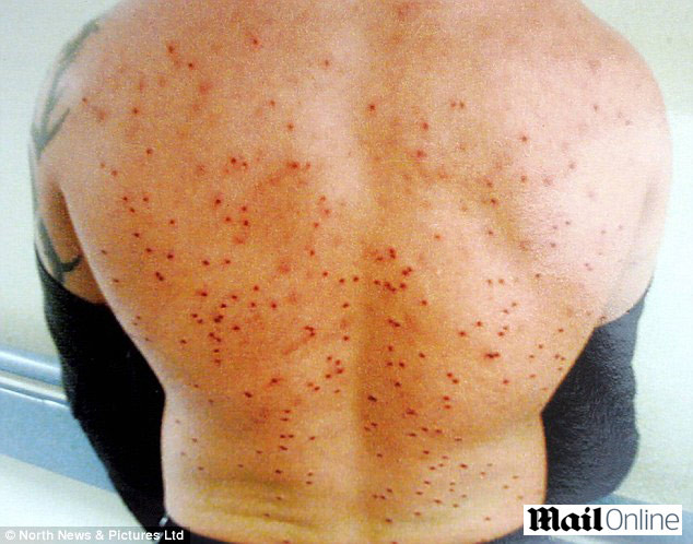 A supravietuit cu 150 de alice in corp, dar va muri cu 25 de ani mai devreme. VEZI RADIOGRAFIA