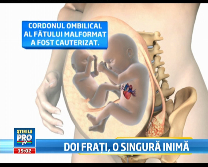 Caz cutremurator: gravida cu gemeni, a aflat in luna a sasea ca unul nu are nici inima si nici cap
