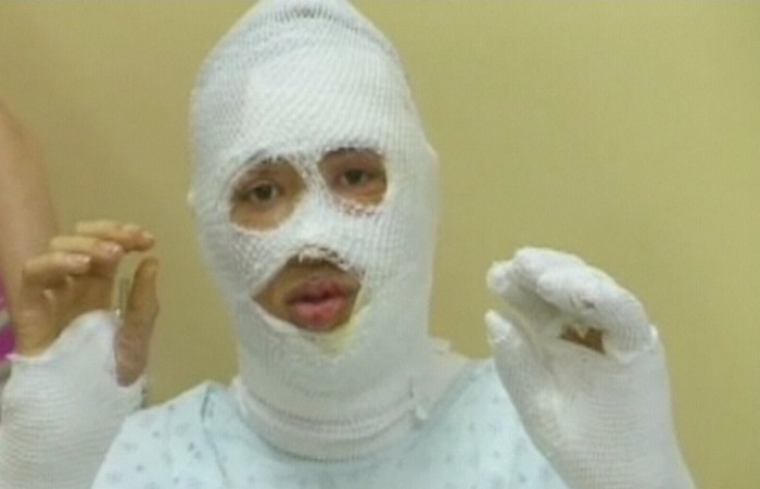 A supravietuit, dupa ce iubitul mamei i-a dat foc, in timp ce dormea. Vezi cum arata. VIDEO