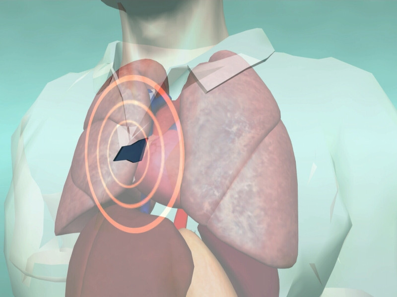 A trait doua luni cu un ciob de sticla, lung de 6 centimetri, infipt langa inima