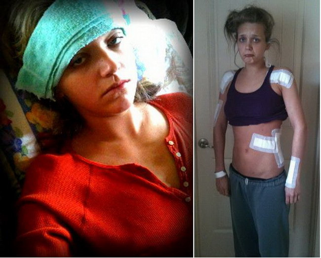 Ea este femeia care la 26 de ani traieste cu peste 1000 de tumori. Vezi cum este viata ei!