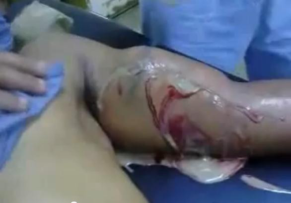 Caz socant pentru medici. Ce a patit un barbat, dupa ce si-a injectat steroizi. VIDEO EXPLICIT