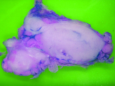 Tratament revolutionar: a aparut pastila care inlocuieste chimioterapia