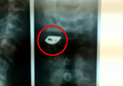 Medicii din Iasi i-au gasit unui pacient o catarama de ceas in gat: Aveam senzatia de jena de 10 ani