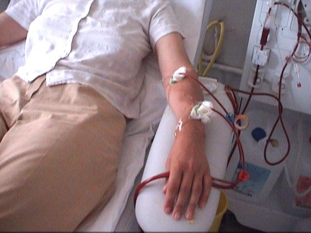 Bolnavii care necesita dializa,chemati sa se interneze in spital pe durata codului galben de ninsori