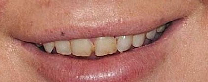 Viciile i-au distrus dantura. Actrita de doar 25 de ani nu mai poate zambi