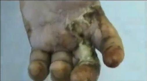 Drogul de 2 euro doza care macina trupurile, ultima mare amenintare a Europei. Imagini SOCANTE