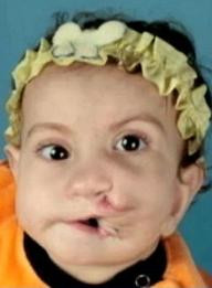 VIDEO. Un caz unic in lume, care i-a uimit pe medici - fetita nascuta cu doua guri