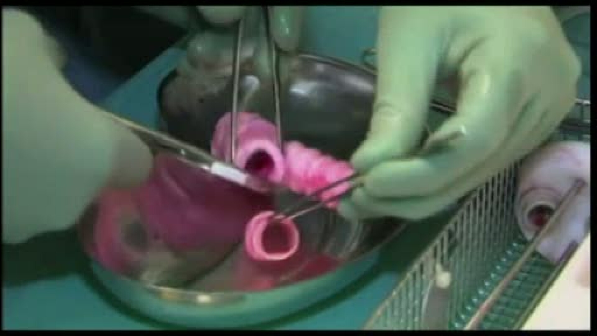 Tesutul care ar putea insemna viitorul in materie de transplant de organe