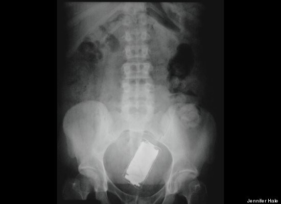 Cum a ajuns un iPod intr-un astfel de loc. Medicii, socati de ceea ce vad la radiografii. FOTO