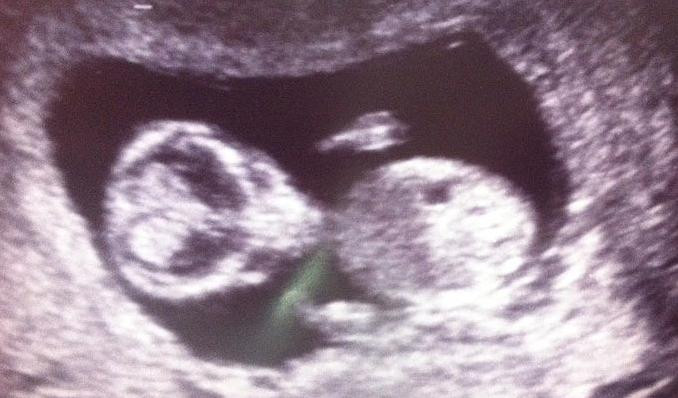 Ecografia care i-a lasat muti de uimire. O femeie asteapta sa aduca pe lume un extraterestru