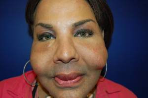 Chipul de piatra. Mutilata pe viata de un doctor care i-a facut implanturi cu CIMENT. VIDEO