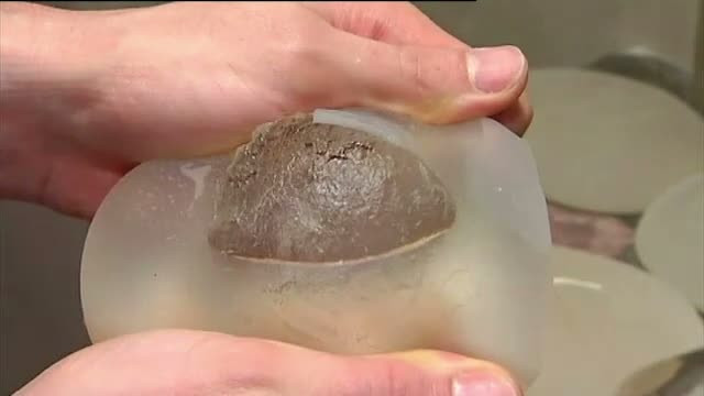 Scandalul silicoanelor nu ocoleste nici Romania. Mii de femei, avertizate de medici