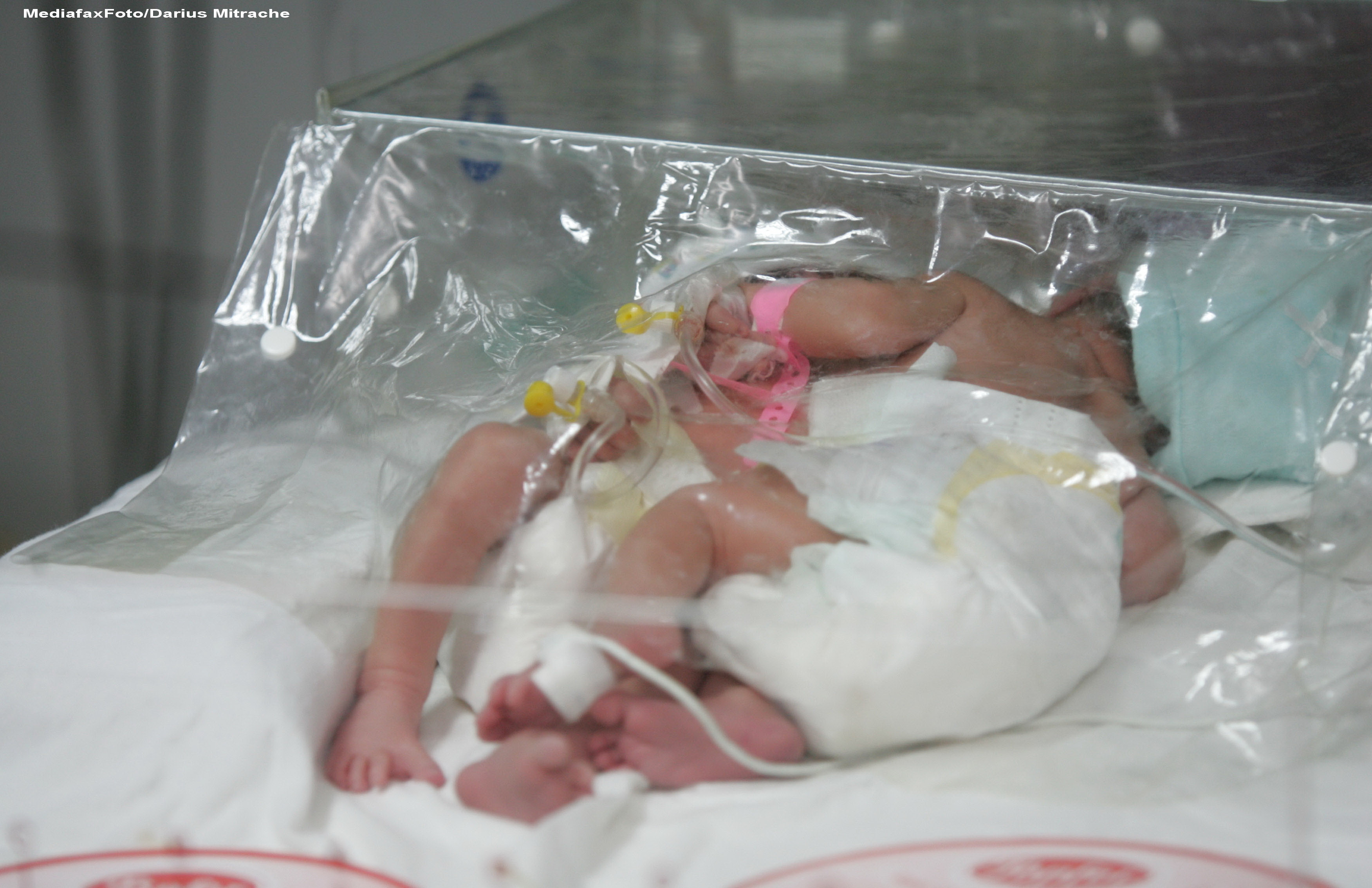 Ce sanse la o viata normala au siamezele nascute la Pitesti. Ultimele 5 cazuri de la noi - esecuri