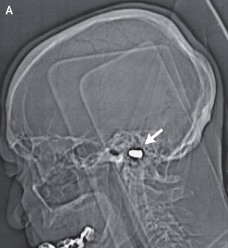 Descoperire fenomenala in creierul unui barbat. Doctorii, uimiti: cum a trait cu asa ceva 82 de ani?