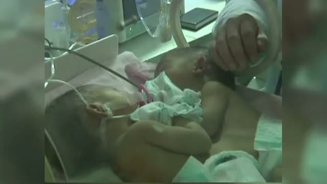 Una dintre siamezele nascute la Pitesti are probleme cu rinichii. Medicii sunt insa optimisti