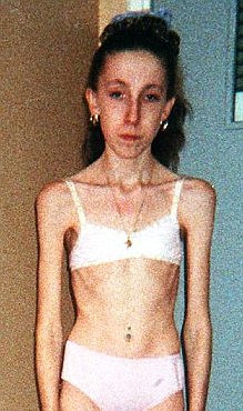 Anorexic la trei ani. Medicii, ingroziti de situatia dezastruoasa cu care se confrunta