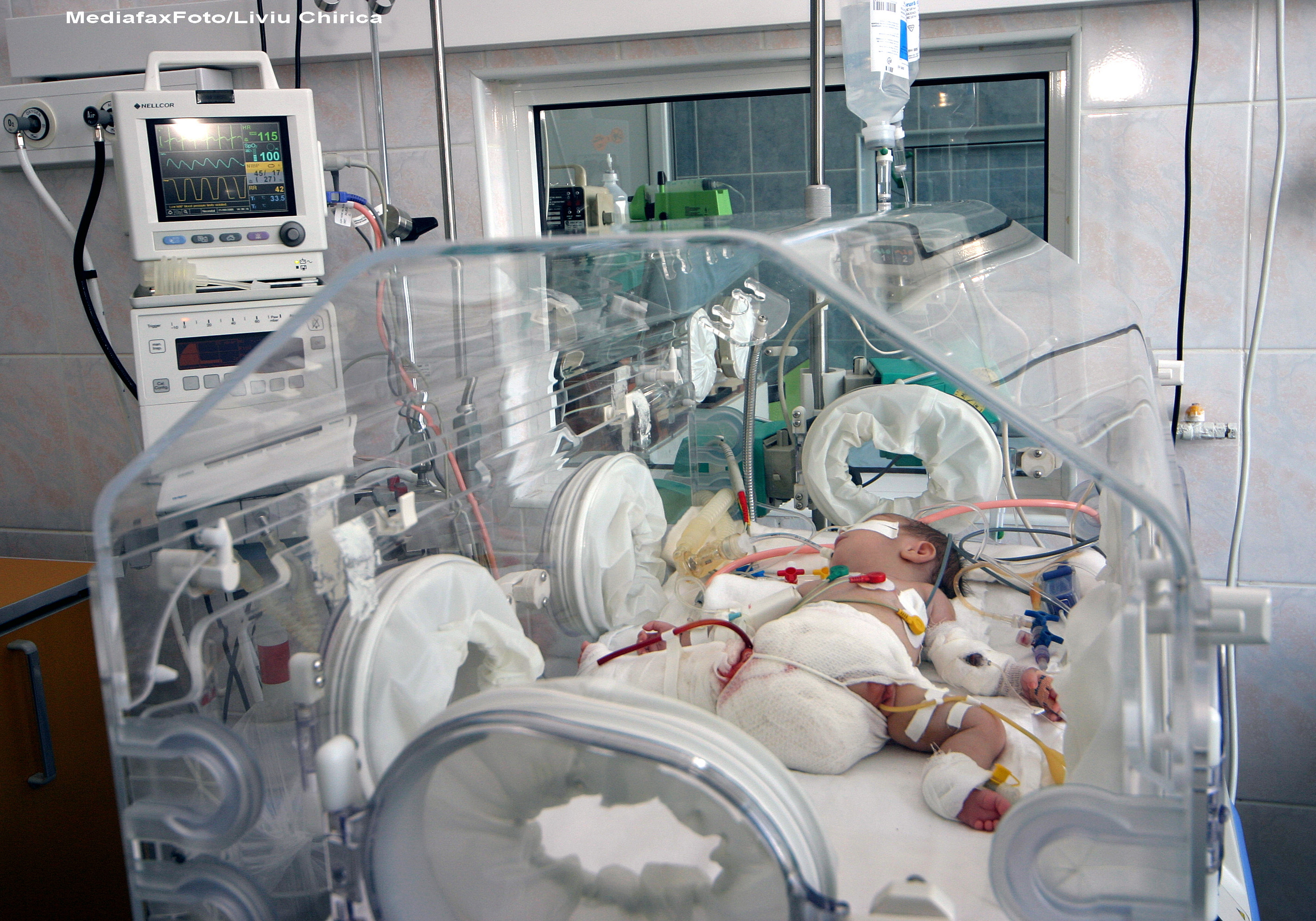 Pentru ca ea sa supravietuiasca, sora ei siameza a trebuit sa moara. Dupa 14 ani, a aflat despre povestea lor de pe internet