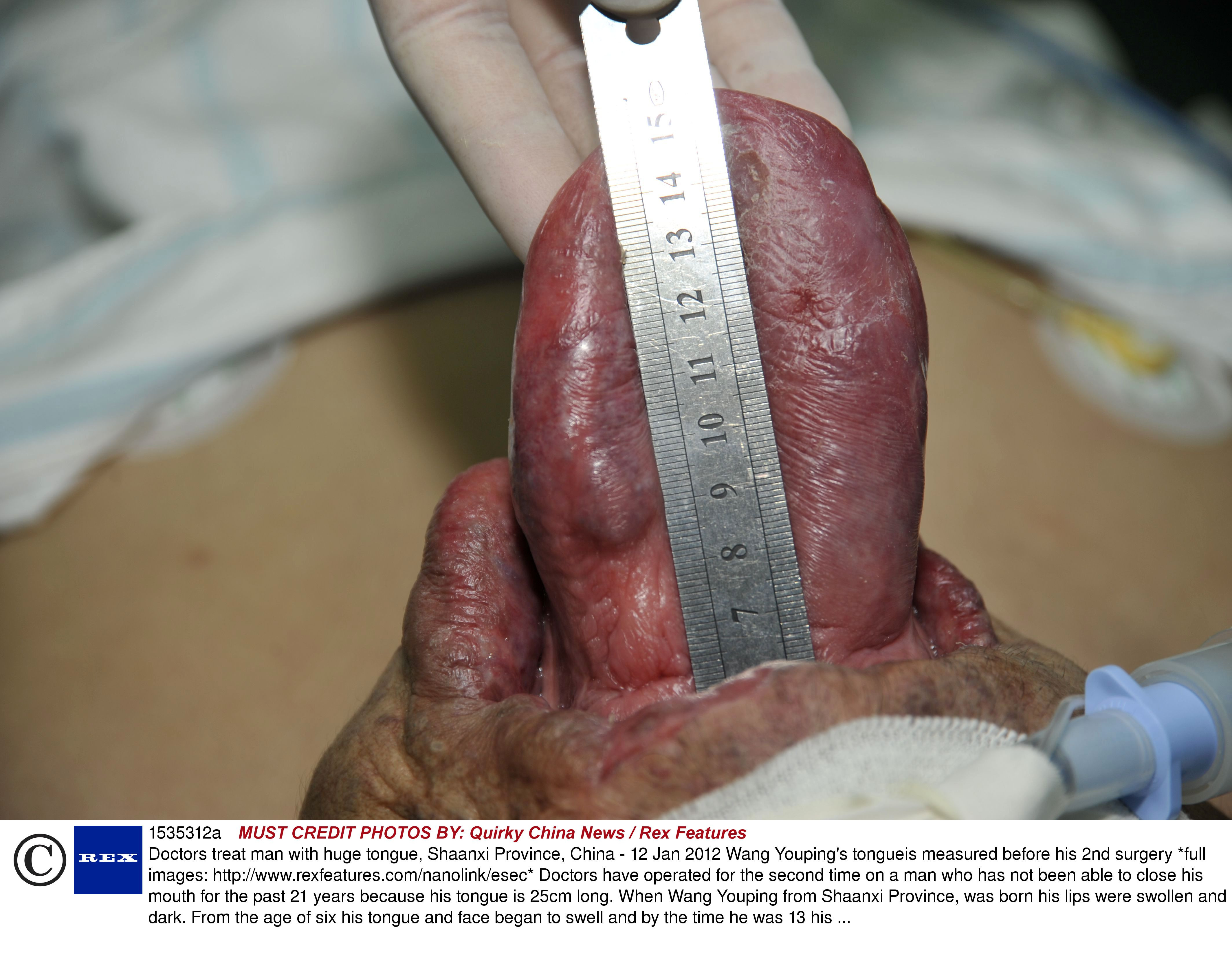 Nu a mai inchis gura de 21 de ani, la propriu. Cosmarul de zi cu zi care i-a distrus viata. FOTO