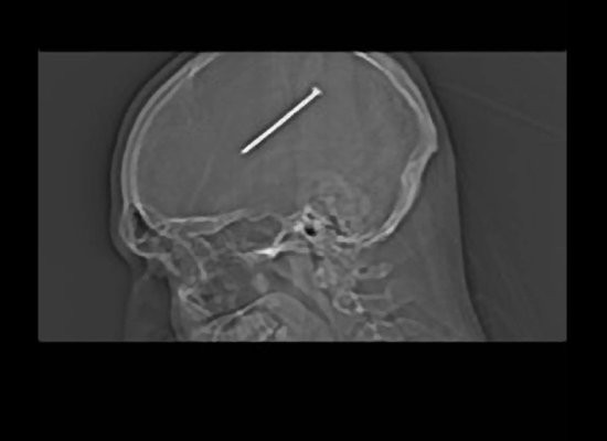 I-a blocat pana si pe medici.Ce au gasit in creierul unui barbat. Pacientul nici macar nu stia.VIDEO