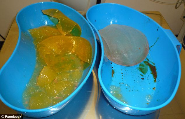 “S-au umflat pana au ajuns la marimea capului meu, dupa care au explodat”. O imagine greu de privit