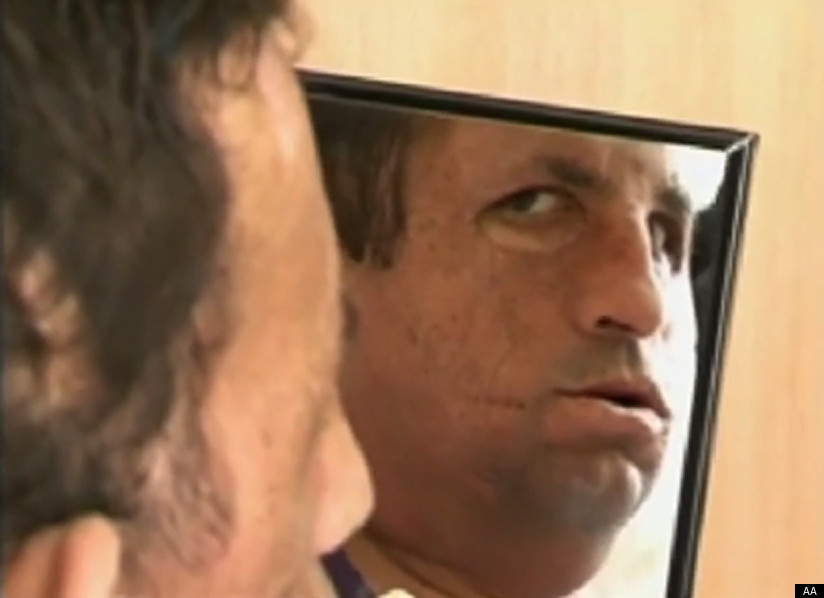 VIDEO. Cum a reactionat un tanar cand si-a vazut noul chip, dupa un transplant de fata