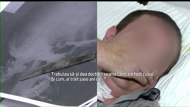 De 6 ani traia la cativa centimetri de moarte. Radiografia unui barbat din Iasi i-a uimit pe medici