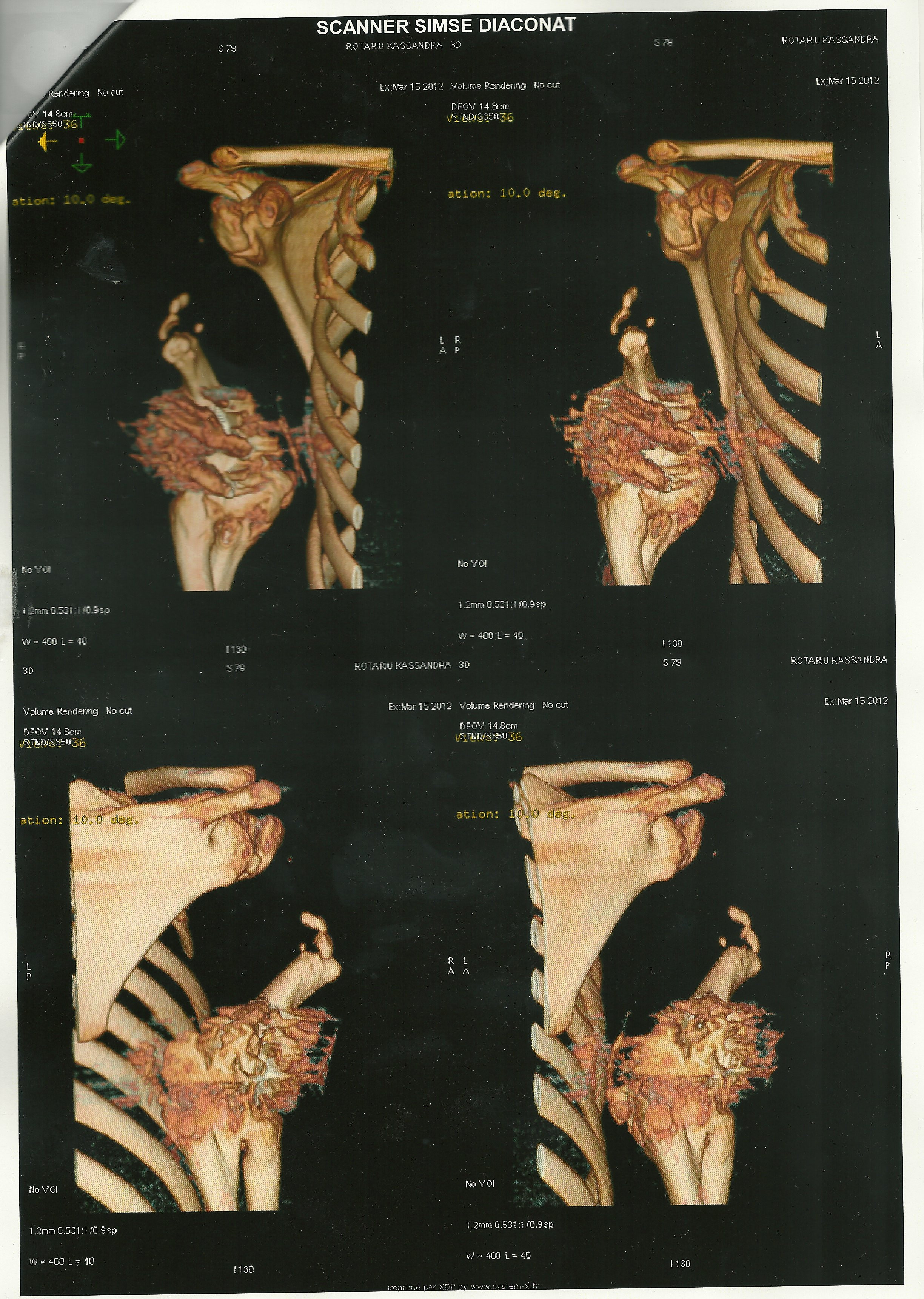Fetita lui Roti continua lupta. Vezi urmele cumplite lasate de bunica naturala a Kassandrei