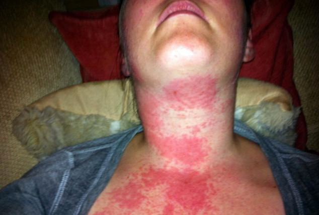 Asa arata dupa ce a vorbit la telefonul ei iPhone 4. Medicii au fost ingroziti cand au vazut-o