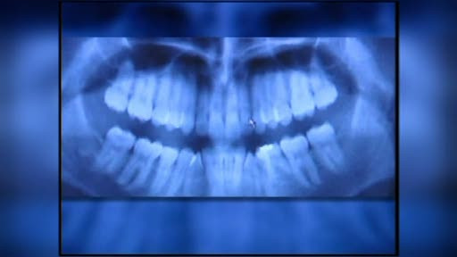 Un anumit tip de radiografie dentare creste riscul aparitiei unei tumori pe creier cu pana la 90%