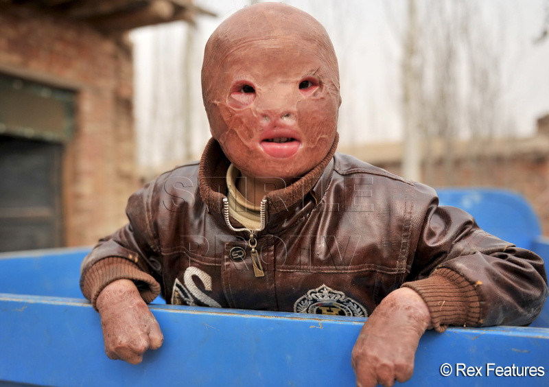 Clipa fatala care l-a transformat intr-o masca vie. Viitor sumbru pentru un copil de 6 ani