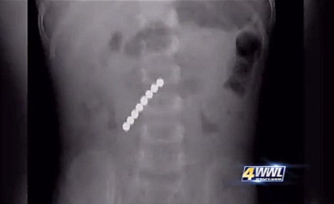 VIDEO. Copil de 2 ani, in stare critica, dupa ce a inghitit 8 magneti."N-o sa credeti ce i-au facut"