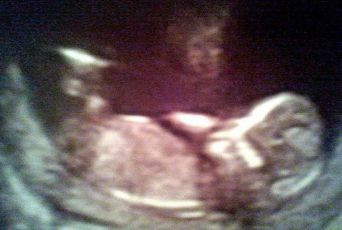 Anuntul socant al medicilor, dupa ce au consultat-o pe femeia care poarta 9 copii in pantece