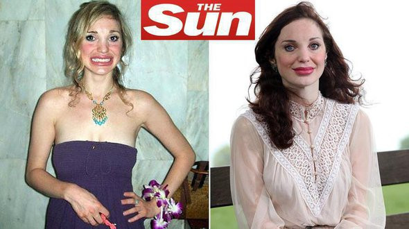 "Am vrut sa fiu frumoasa, dar am devenit un monstru". Unde a dus-o obsesia pentru buze