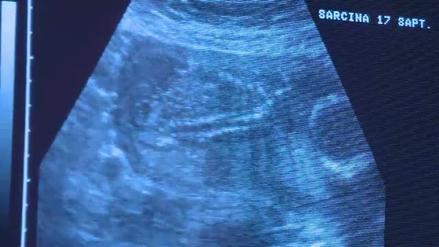 O romanca a facut CHIURETAJ, dar e in continuare GRAVIDA. Explicatia doctorului te lasa fara cuvinte