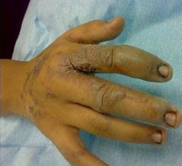 Un barbat din China a ramas diform dupa ce un iPhone i-a explodat in mana