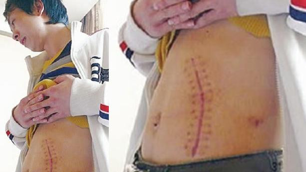 "Doneaza un rinichi, cumpara un iPad" Cum creste piata neagra a transplanturilor:O afacere de 1.5mld