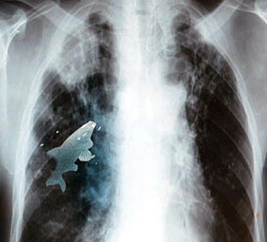 Pestele viu din plamanul unui baiat din India. Chirurgul sau: "In 20 de ani, n-am vazut asa ceva"