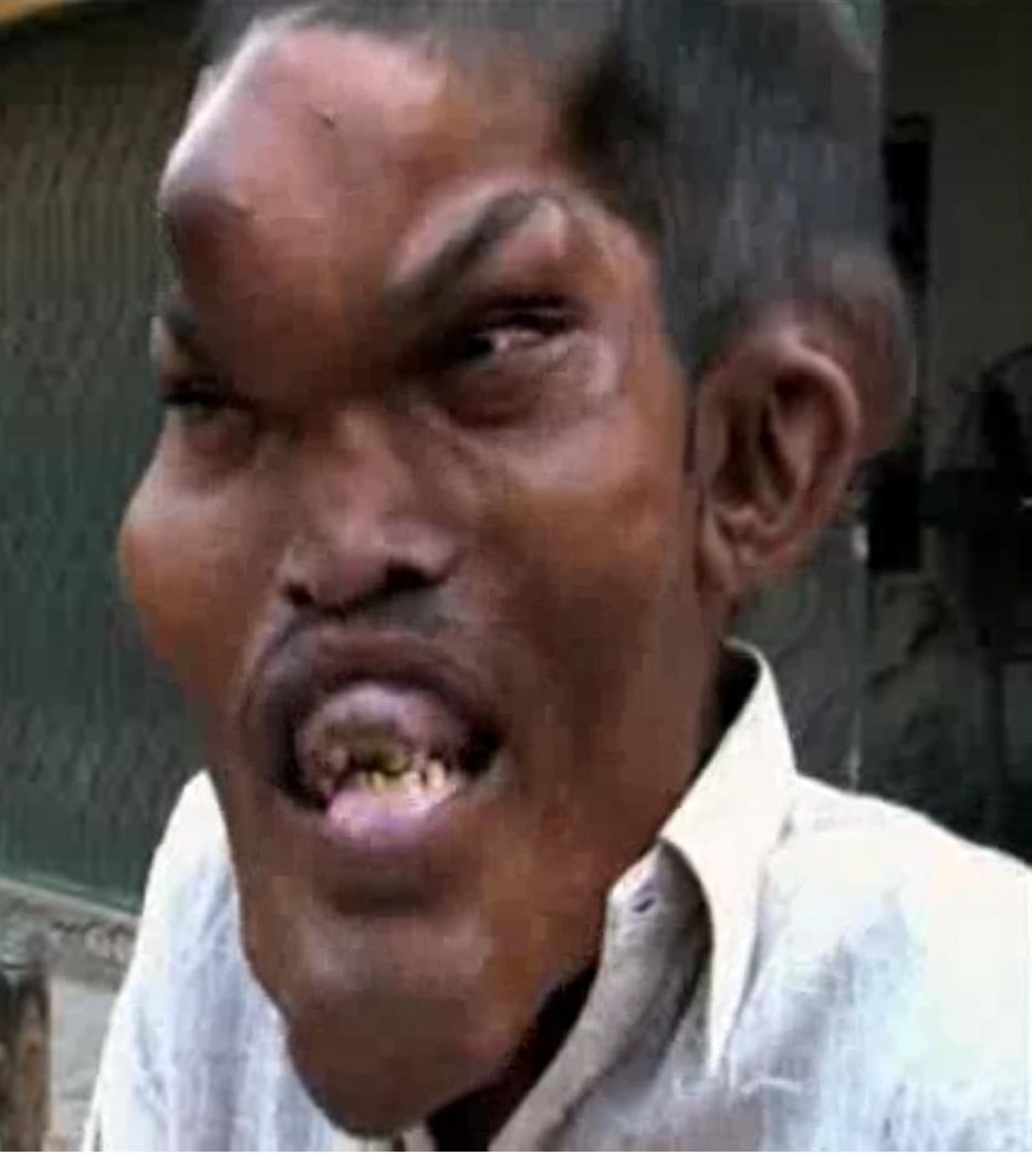 VIDEO. Povestea omului desfigurat de o boala rara. "Sper ca intr-o zi sa imi gasesc o iubita"