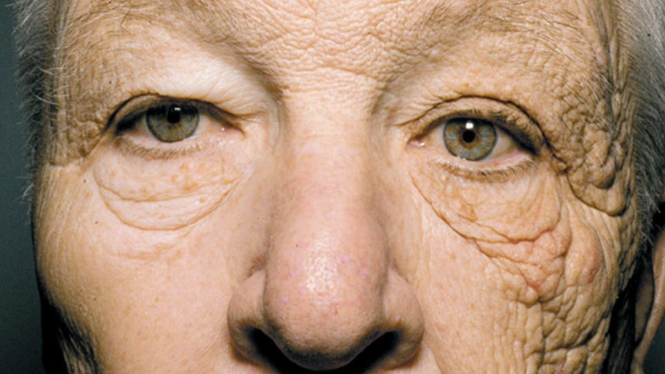 FOTO.Omul cu jumatate de fata imbatranita prematur. Explicatia perfect logica pentru aceasta imagine
