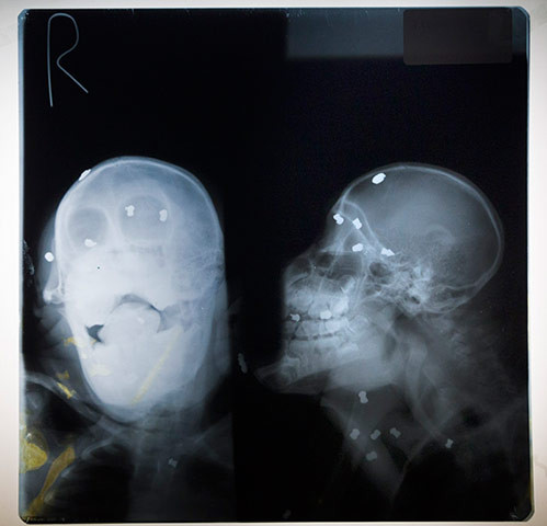 Impuscat de 62 de ori,refuza sa moara.Povestea urangutanului care a inviat din mainile braconierilor