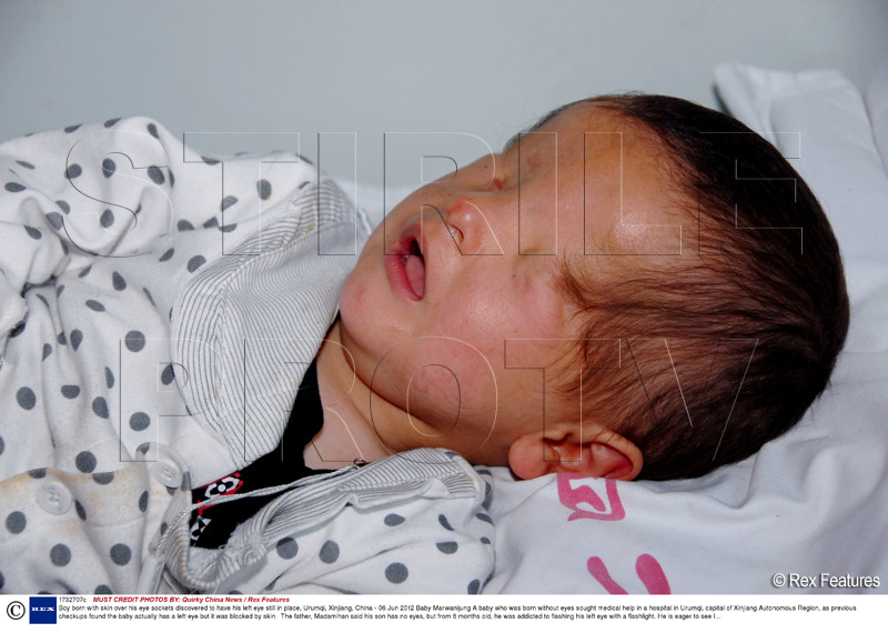 FOTO. Acest copil i-a uimit pe medici. S-a nascut fara ochi, dar adora lumina