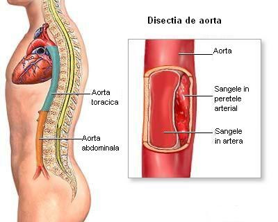 Disectie de aorta