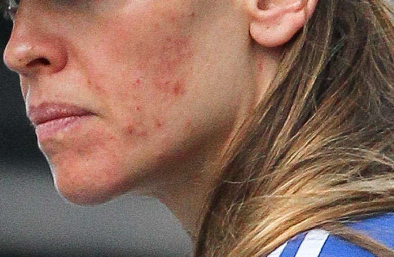 Fata uneia dintre cele mai dorite actrite de la Hollywood, distrusa de acnee. Asa arata fara machiaj