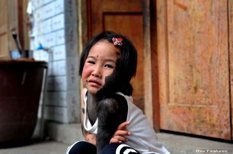 Un nou tratament pentru oamenii care sufera de sindromul varcolaclui