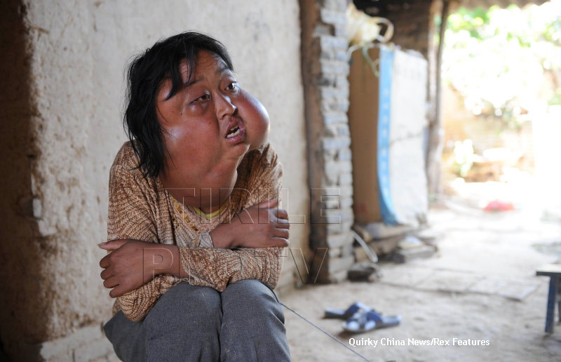 "Sunt un om normal, nu un monstru". Drama femeii care are sapte tumori pe fata. GALERIE FOTO