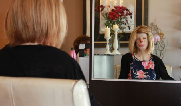 "Pompierii au crezut ca sunt o papusa topita". O poveste tulburatoare din spatele unui chip deformat