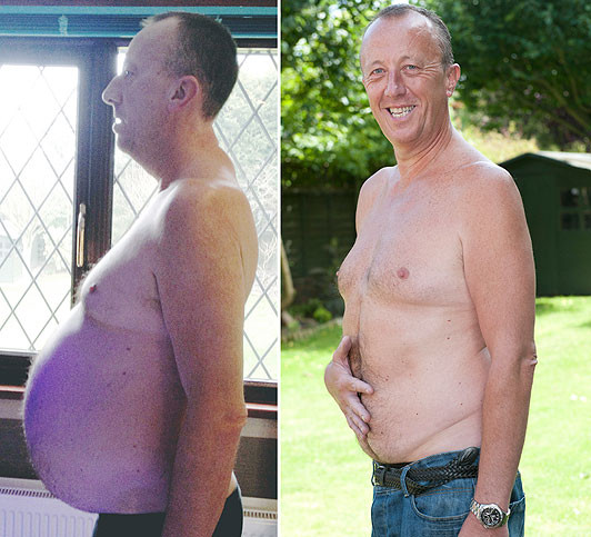 FOTO. A fost convins ca are "burta de bere". Adevarul putea insa sa-l omoare